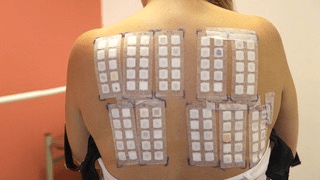 allergy patch testing: dozens of small medical patches attached to the back of a person to determine what substances are allergens.