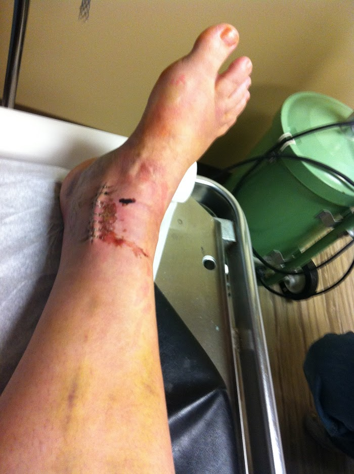 picture of a foot and ankle with staples and stitches from surgery-inside view