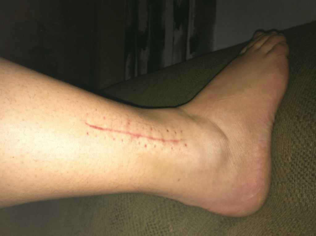 picture of a foot and ankle with scars from surgery outside view